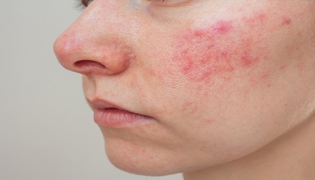 Gül hastalığı nedir? Gül hastalığı belirtileri, nedenleri ve tedavisi