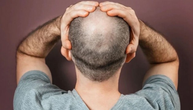 Saç dökülmesini engelliyor kellik tarihe karışıyor