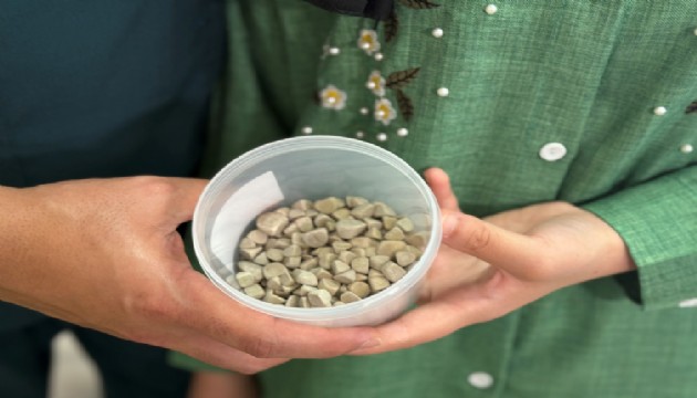 Akılalmaz olay! Vücudundan 287 tane taş çıkarıldı