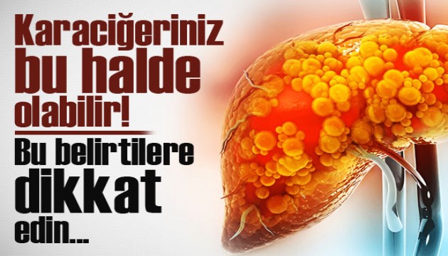 Karaciğeriniz bu halde olabilir! Bu belirtilere dikkat edin!