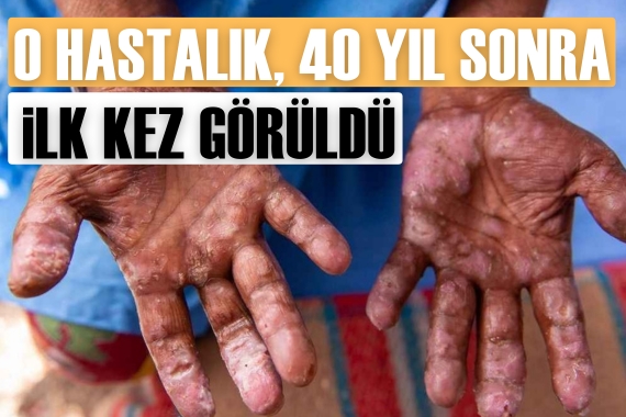 Avrupa'da cüzzam paniği