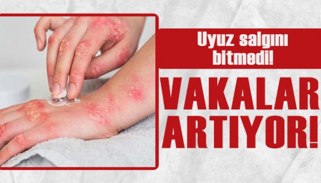 Uyuz vakaları artıyor! Salgın geçmedi!