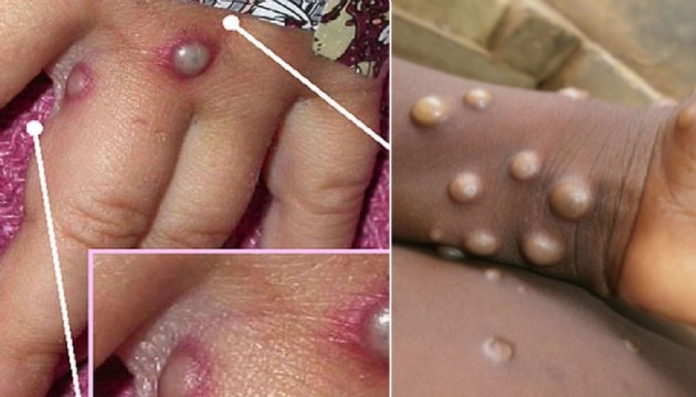 Maymun Çiçeği vakaları artıyor