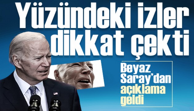 ABD Başkanı Biden'ın yüzündeki izler dikkat çekti: Beyaz Saray'dan açıklama geldi