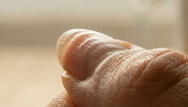 Uzmanlar uyarıyor: Dalgalı tırnak vücudun alarmı
