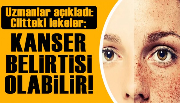 Uzmanlar açıkladı: Ciltteki lekeler kanser belirtisi olabilir!