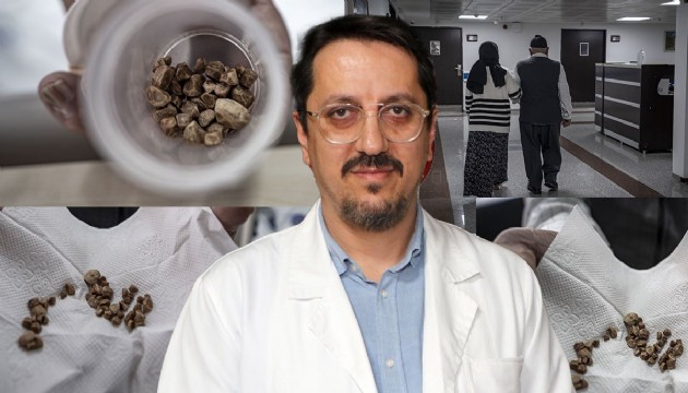 İdrar kanalından 51 taş çıkarıldı