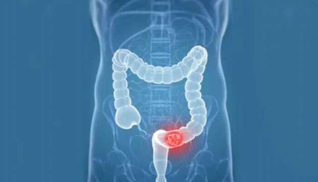 Bağırsak kanserinin beş 'ağrısız' belirtisi açıklandı