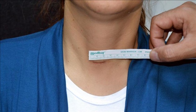 Tiroid nodülleri için ameliyatsız tedavi