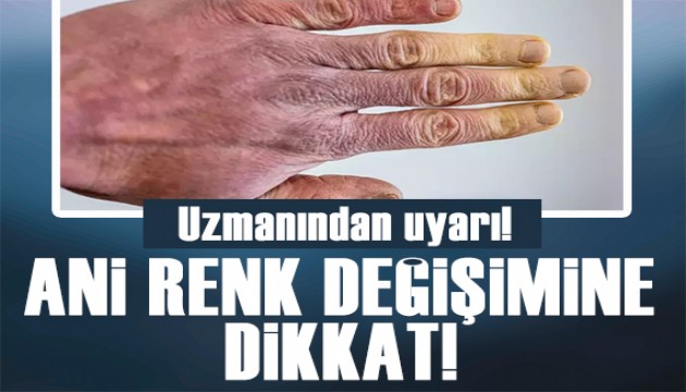 Uzmanından uyarı: Ani renk değişimine dikkat!